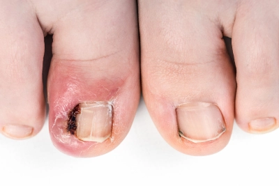 Ingrown nails, usually occor on the big toe