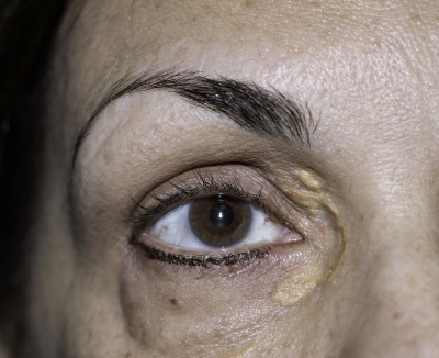 Yellow eyelid marks (xanthelasma) 'early warning sign of heart